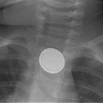 ER Visits Double with Swallowed Battery Hazards Among Young Kids